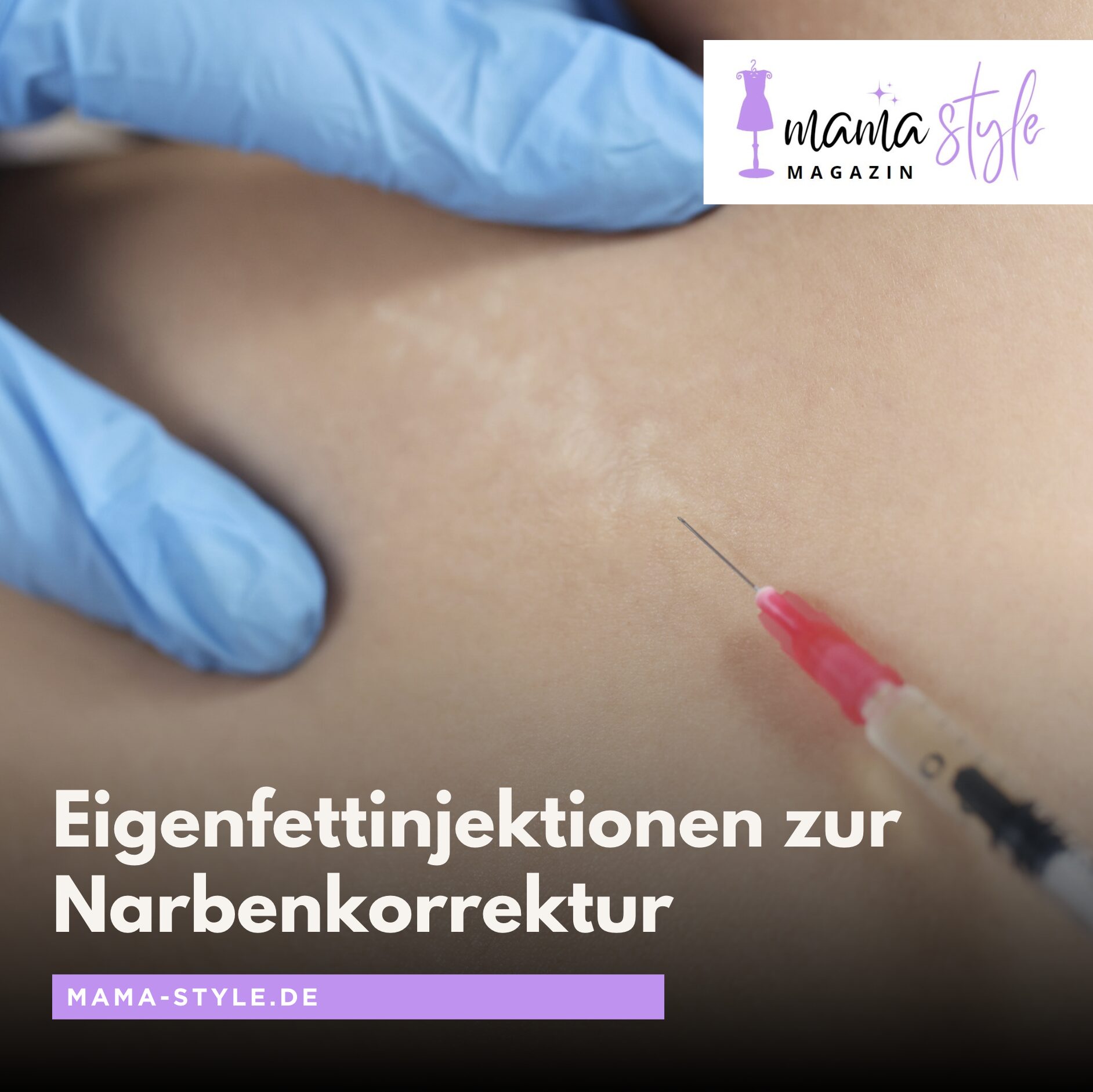 Eigenfettinjektionen zur Narbenkorrektur Eigenfettinjektionen zur Narbenkorrektur