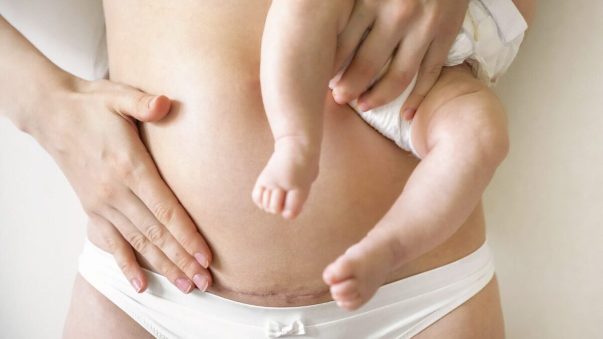 Vorher-Nachher-Vergleich der Kaiserschnittnarbe