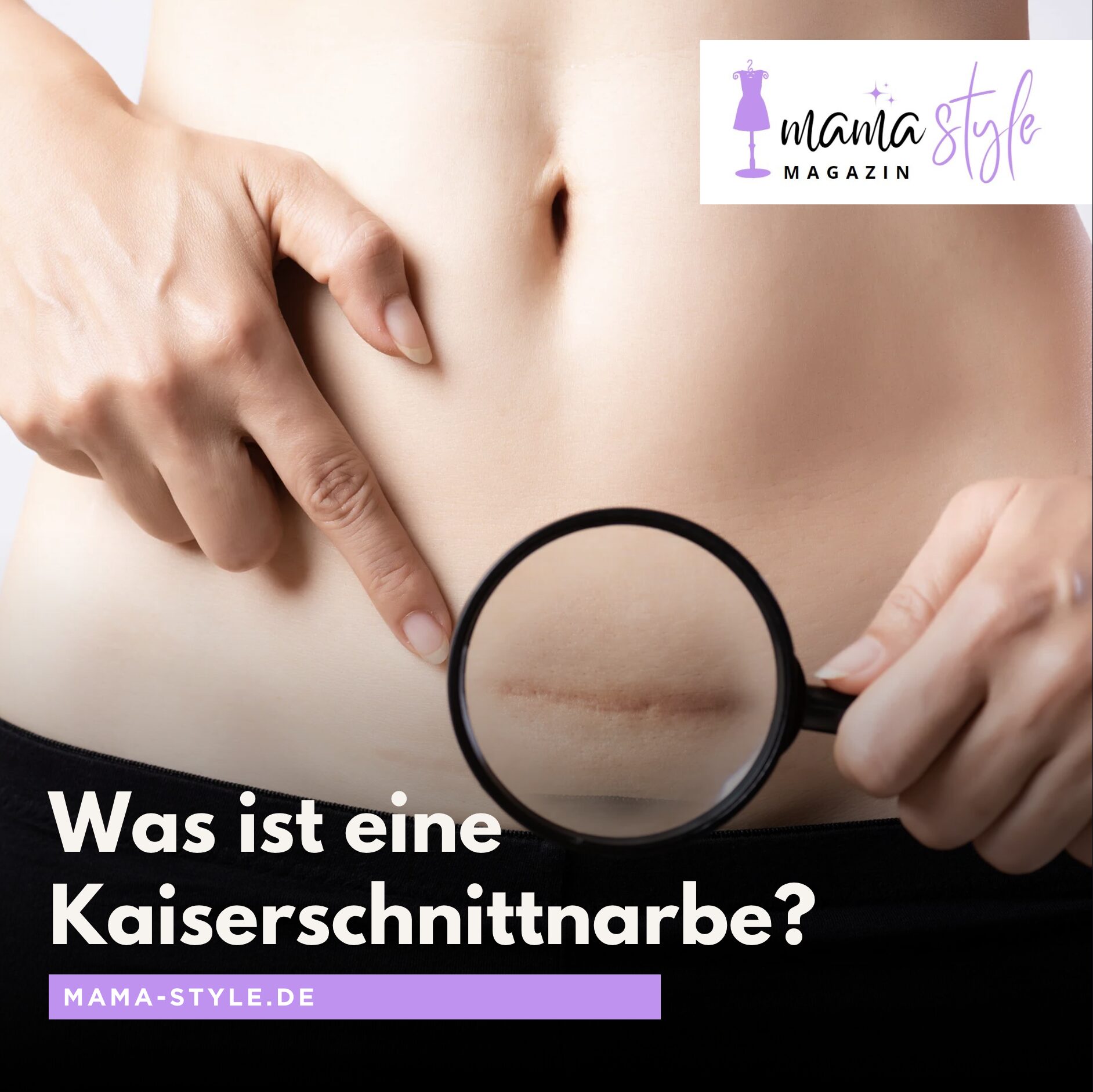Was ist eine Kaiserschnittnarbe? Was ist eine Kaiserschnittnarbe?